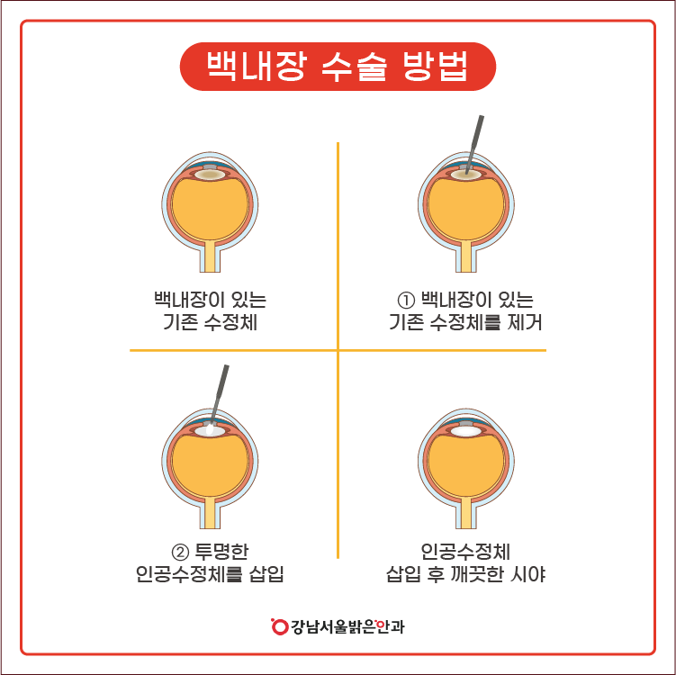 [백내장 수술] 사물이 뿌옇게 보이거나 전등을 볼 때 눈부시면?