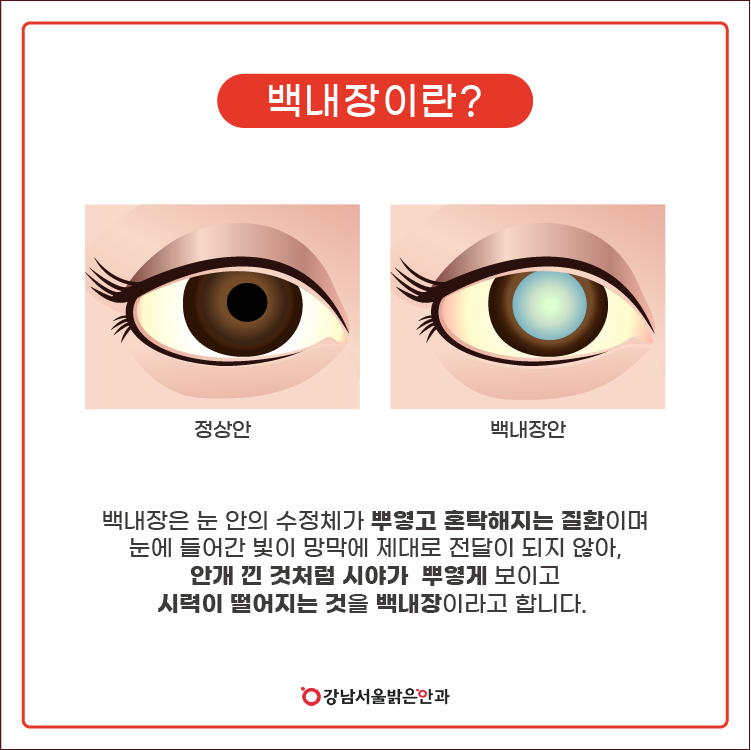 백내장 초기 증상이 의심되는 현상으로 참고할 점
