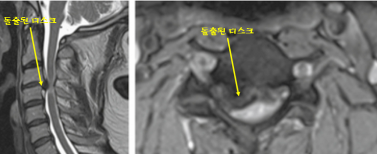  척추 Q&A, 연성디스크와 경성디스크란 무엇인가?