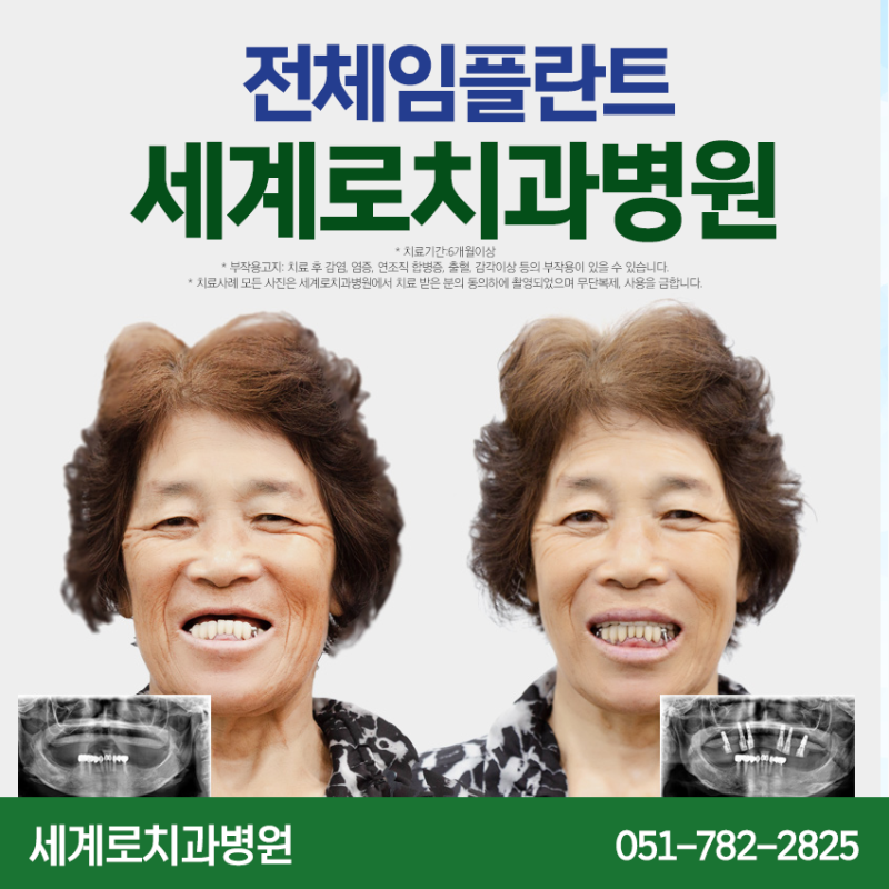 해운대임플란트치과 씹는 즐거움