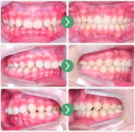 If you have irregular teeth alignment