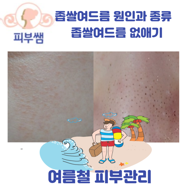  좁쌀여드름 원인과 종류 여름철 피부관리