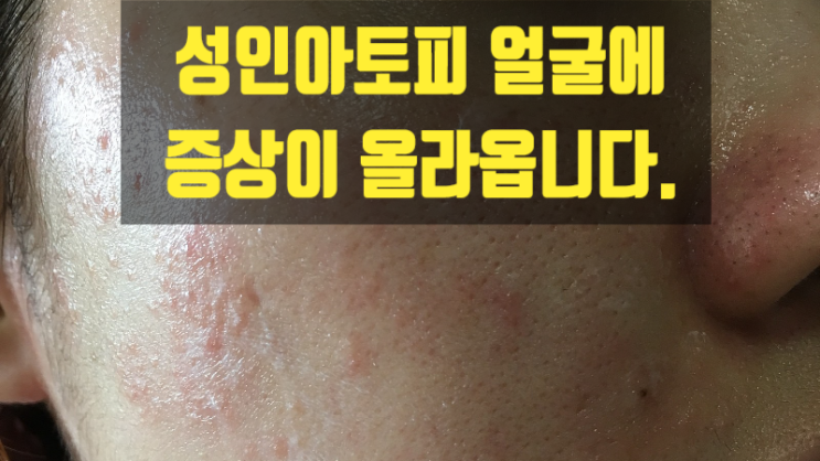 성인아토피 얼굴에 증상이 올라옵니다.