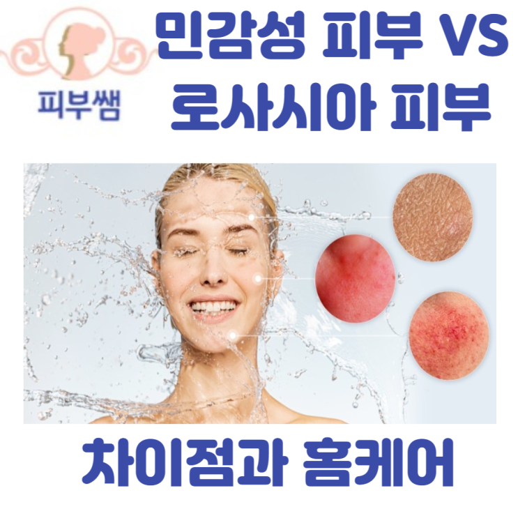  민감성 피부 VS 로사시아 피부 차이점과 홈케어