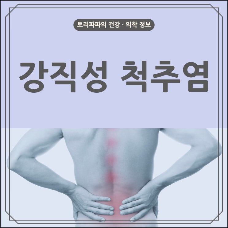  척추 마디가 굳어지는 강직성 척추염의 원인, 증상, 치료