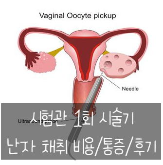  10. 시험관 신선 1차 시술과정기 - 난자 채취 후기, 통증, 비용