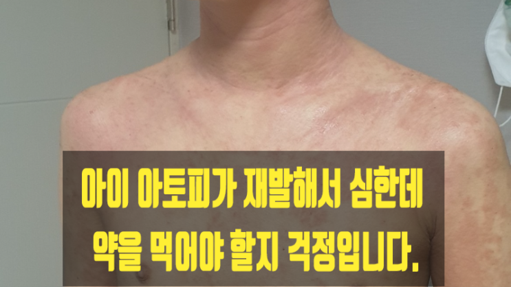  아이 아토피가 재발해서 심한데 약을 먹어야 할지 걱정입니다.
