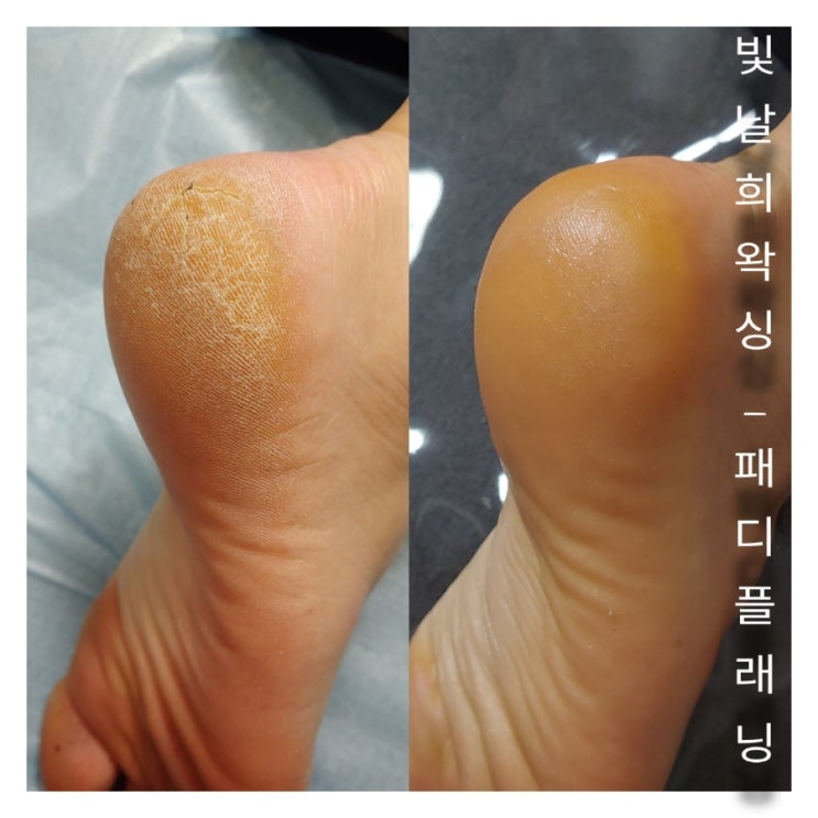  양산 발각질케어 패디플래닝 여름필수 가리지 마세요 빛날희왁싱에서 관리받으세요!