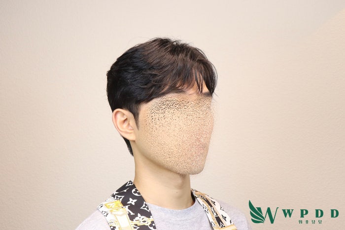 30대 남자 가발(부분맞춤) 위풍당당 리뷰(WPDD대구)