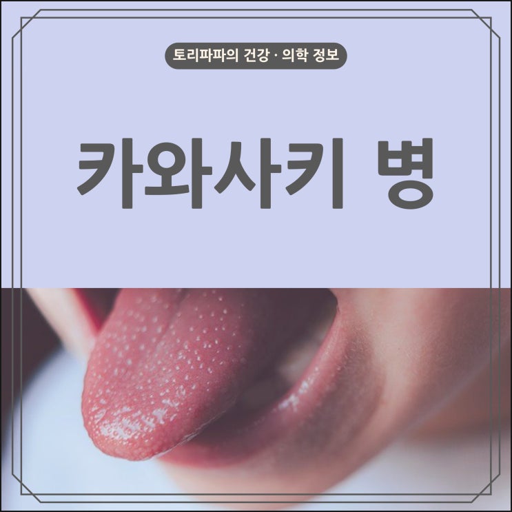 딸기 모양의 혀가 특징인 가와사키병의 원인, 증상, 치료