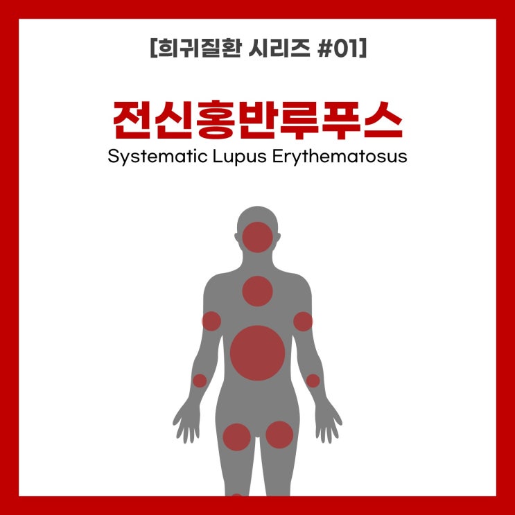  [희귀질환 시리즈 #01] 전신홍반루푸스