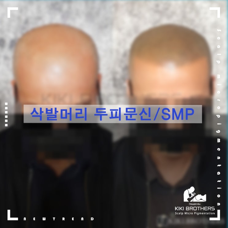  이제 당당히 모자를 벗자!! 삭발머리문신 두피문신/SMP 전문점 키키브라더스 노원