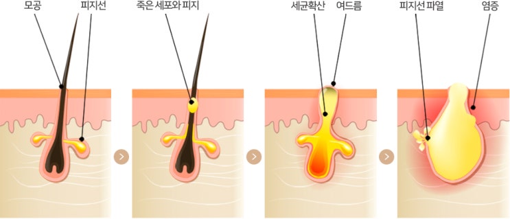  여드름피부엔 스케일링 해야하는 이유