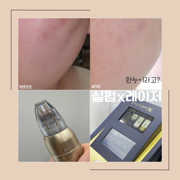 실펌레이저 업그레이드된 실펌X 뭘까? 실펌레이저 업그레이드된 실펌X 뭘까?