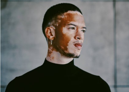  백반증 원인과 증상은? 치료는 가능할까?