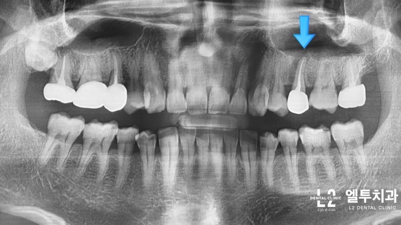 치아 갈라짐(균열), 씹을 때 통증, 신경치료, 소구치 치관 발치, 임플란트