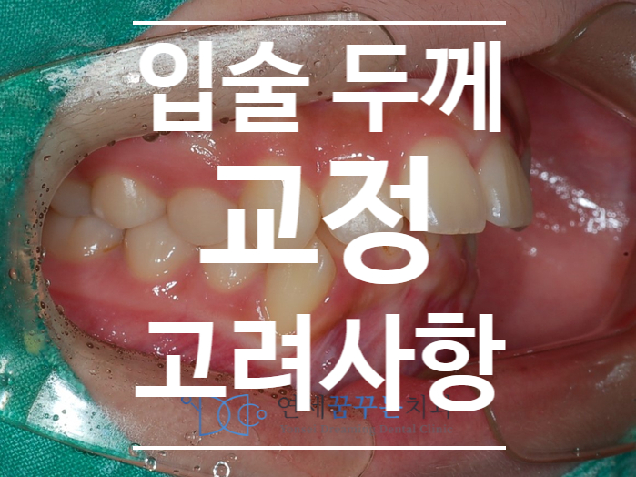 강일 상일 입술 두께에 따른 발치교정 치료 시 입술의 변화 정도