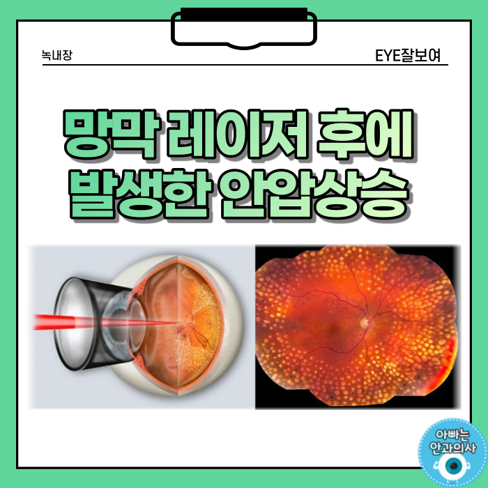  망막레이저 후 안압이 오른 경우