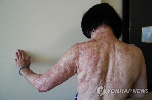 화상흉터치료 끝낸 <b>네이팜탄소녀</b>...심한화상흉터 개선시킨 치료법