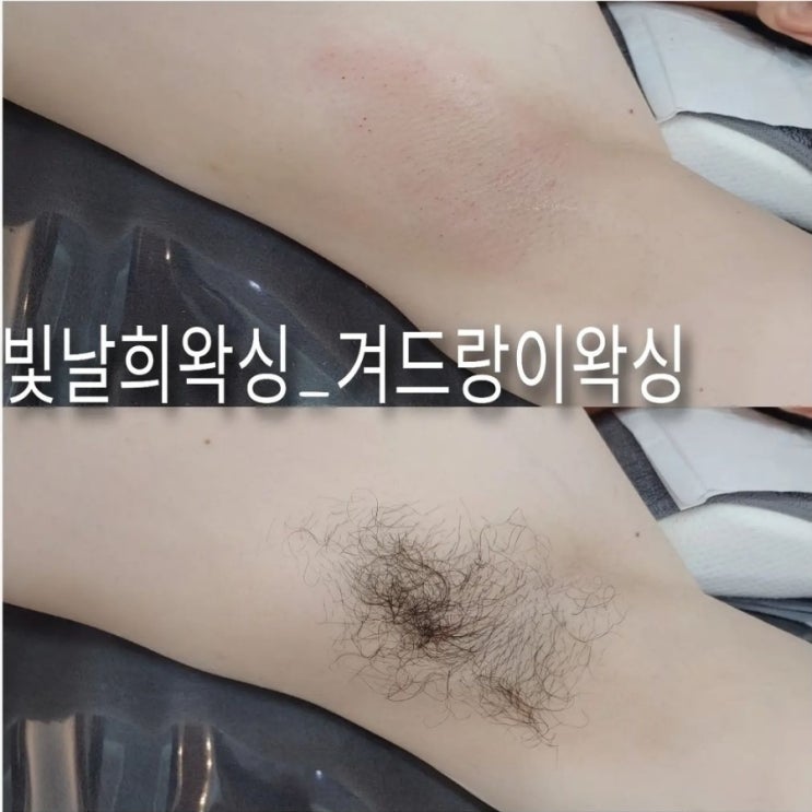  남자도 꾸준한 왁싱관리 겨드랑이왁싱필수죠!