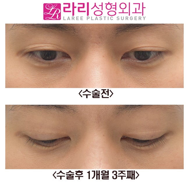 라리성형외과] 오른쪽 매몰 쌍꺼풀재수술 전후 : 네이버 블로그