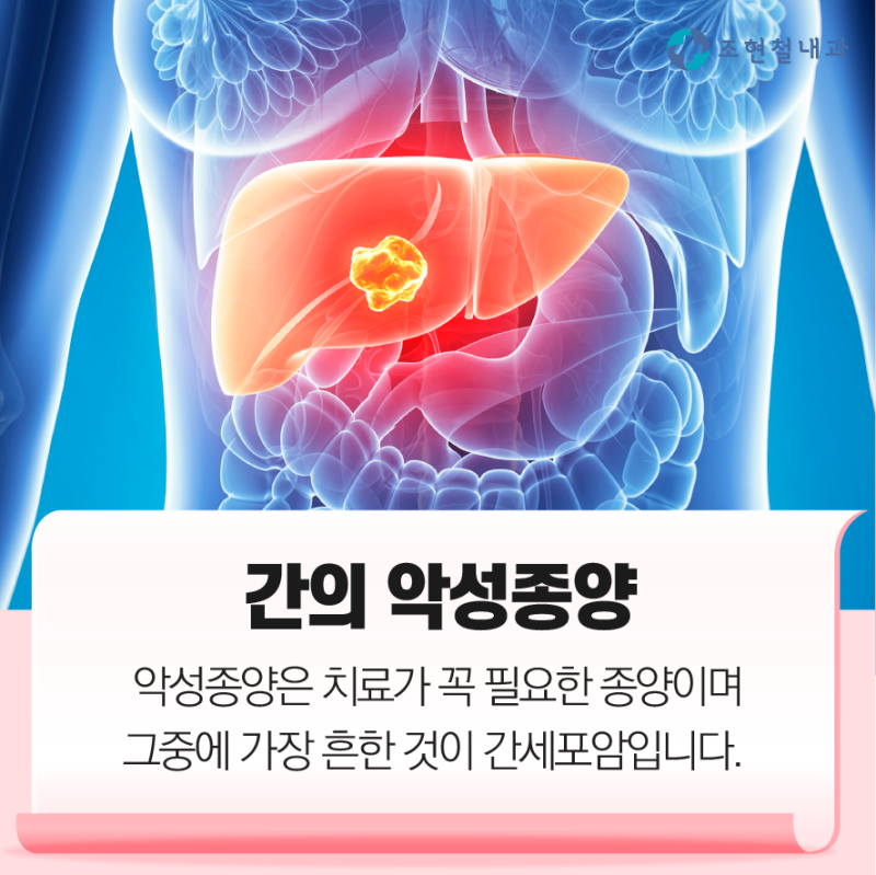 간암 초기 증상, 주범은 만성 간염? 13