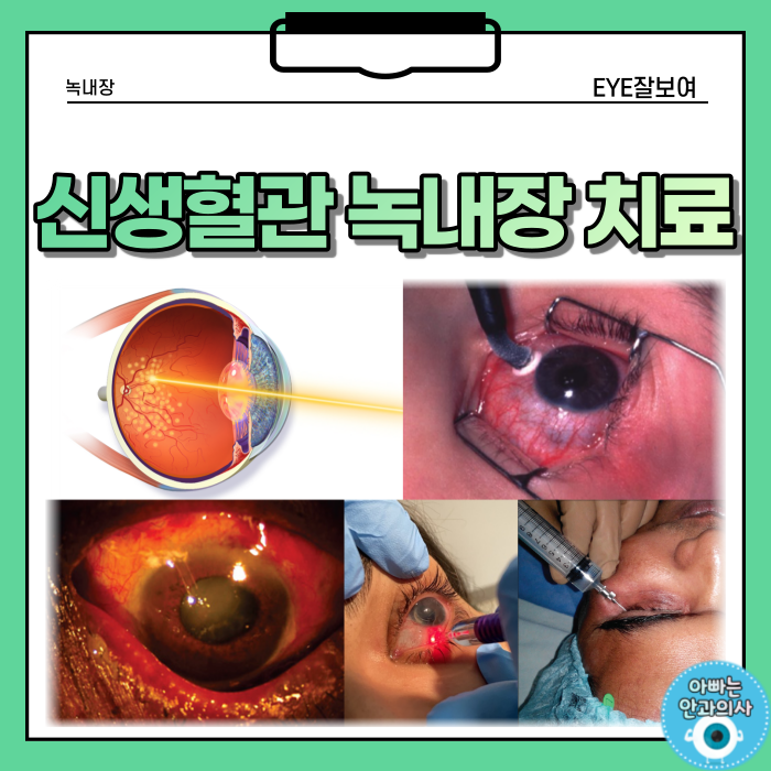  신생혈관 녹내장의 치료