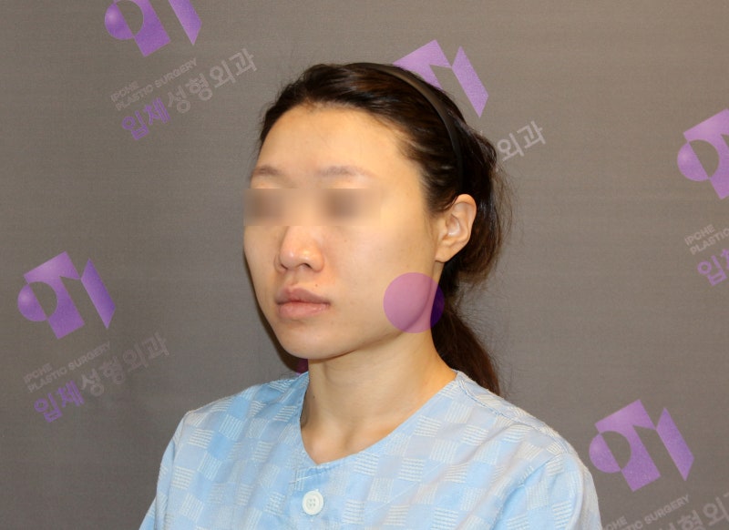 사각턱수술 부작용 이차각과 개턱 현상 : 네이버 블로그