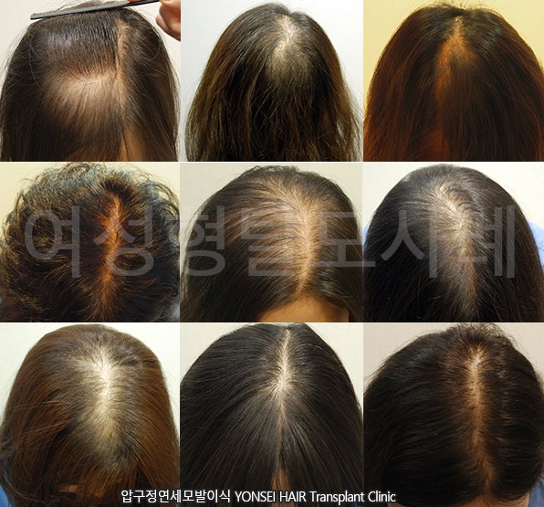 중년 여성 탈모 모발이식을 잘하는 병원은 2