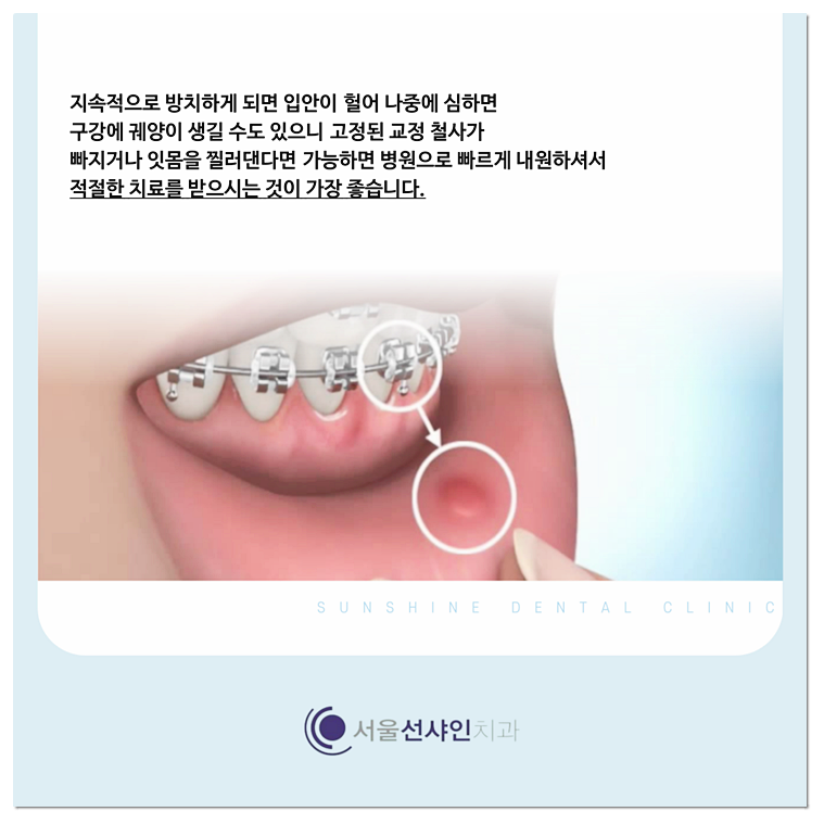 교정철사빠짐, 찔림 현상 대처법은? : 네이버 블로그 교정철사빠짐, 찔림 현상 대처법은? : 네이버 블로그