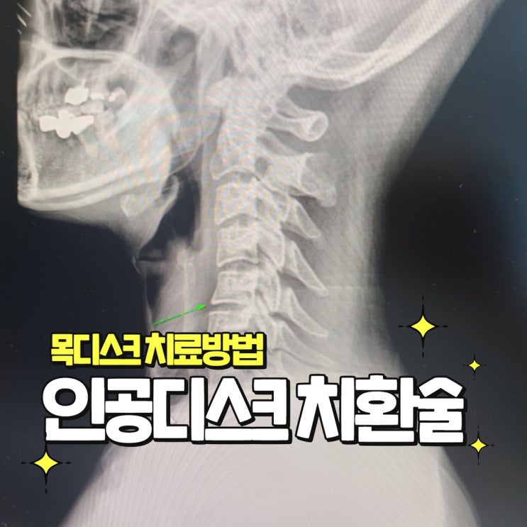  경추 인공디스크 치환술 수술 목디스크 치료방법