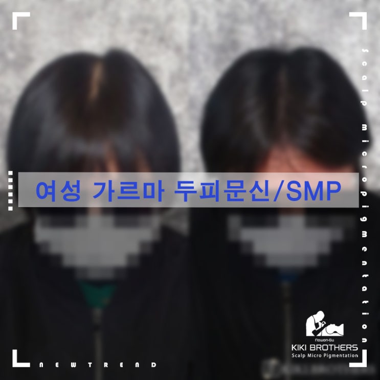  가르마가 점점 밝아진다?? 여성 정수리탈모 두피문신/SMP 전문점 키키브라더스 노원