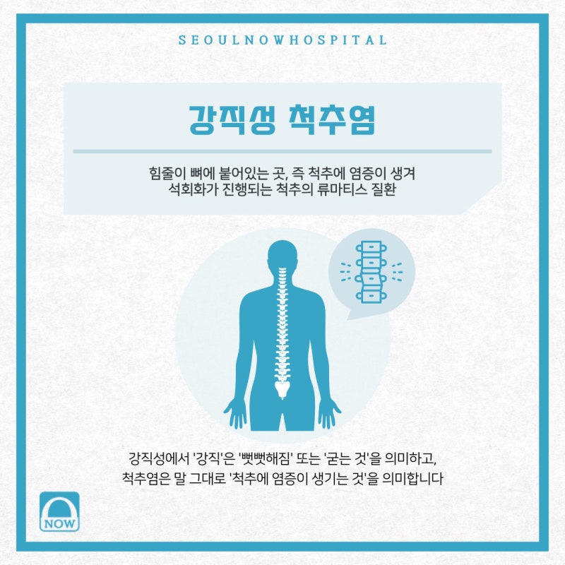허리가 뻣뻣해지는 강직성 척추염 허리가 뻣뻣해지는 강직성 척추염