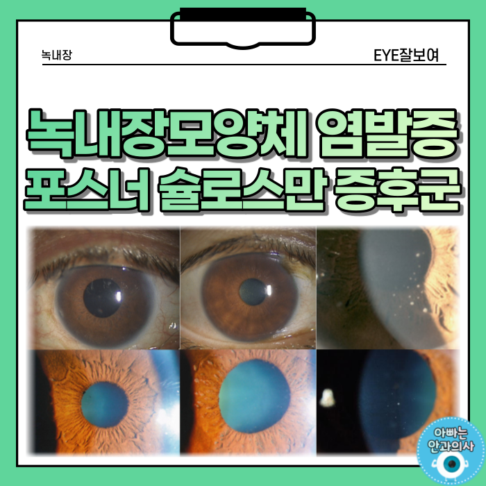  녹내장모양체 염발증(GCC) - 포스너 슐로스만 증후군(PSS)