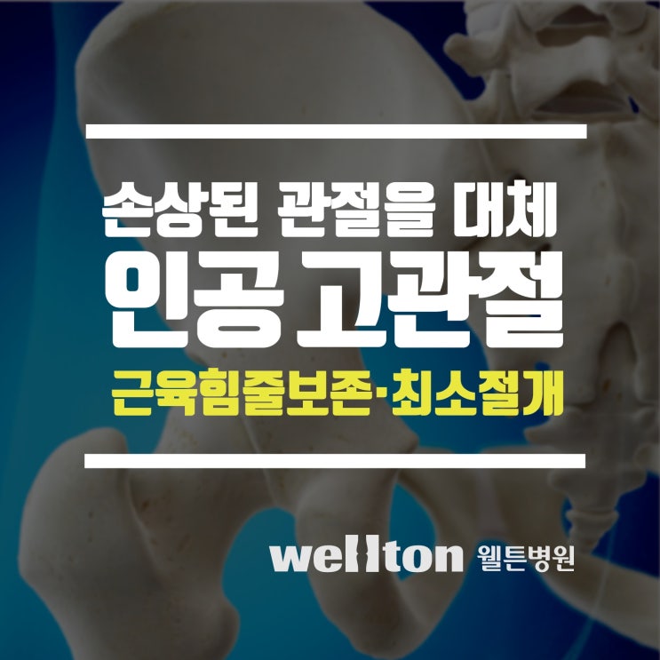  [고관절재활운동] 인공고관절수술 후 혼자서도 따라할 수 있는 재활운동법
