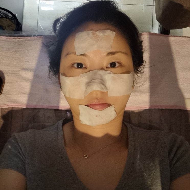  잠실 피부과 2차 시술]  BBL쥴레이저, 어펌 레이저 - 기미 잡티 제거, 브이라인 리프팅 후기