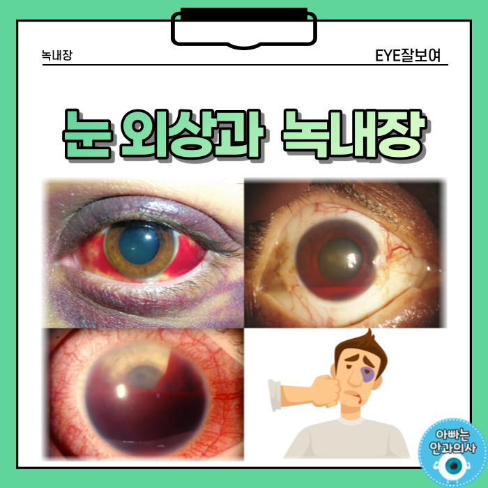  눈을 맞고 생긴 녹내장(안압상승)