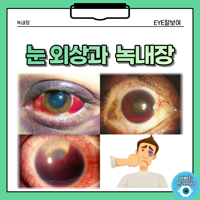 눈을 맞고 생긴 녹내장(안압상승)