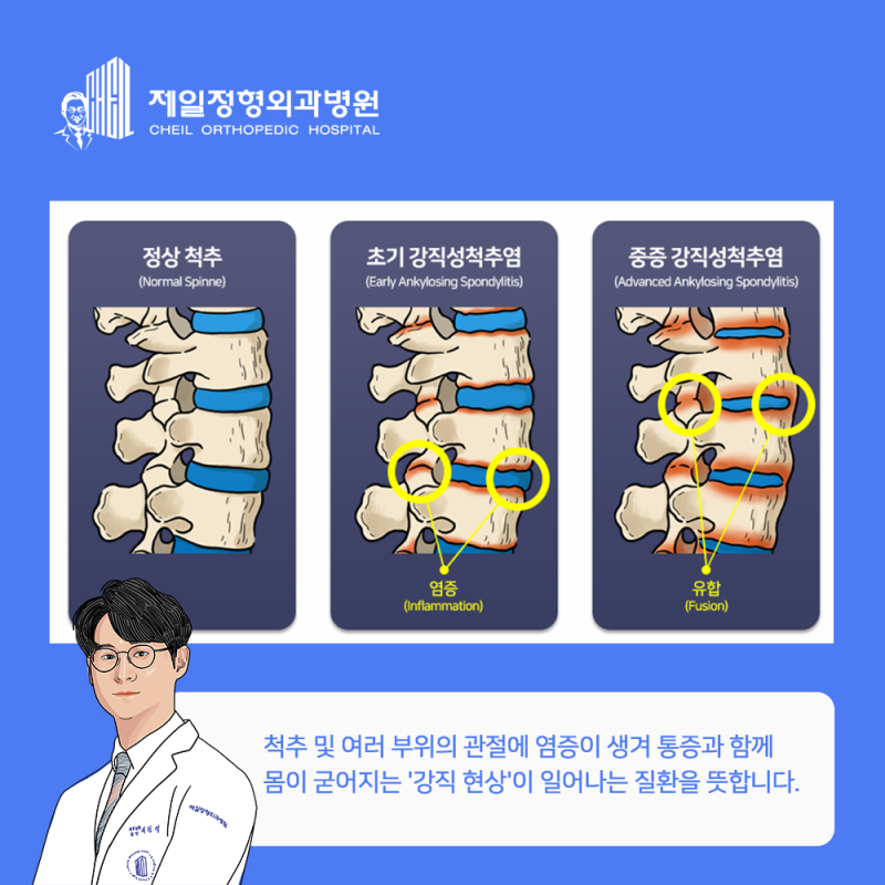 강직성척추염 원인부터 증상까지 총정리