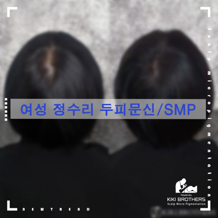  여자도 정수리탈모?? 도봉 두피문신SMP 키키브라더스 노원