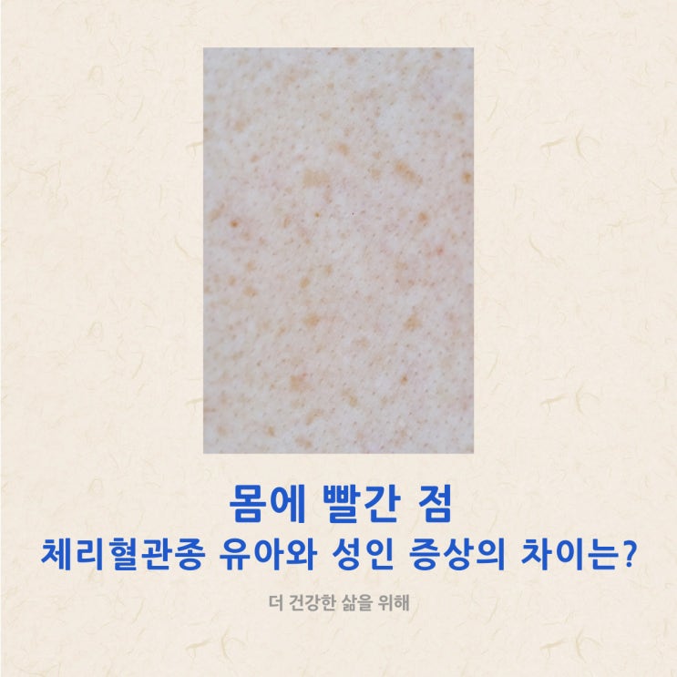 몸에 빨간 점 체리혈관종 유아와 성인 증상의 차이는?