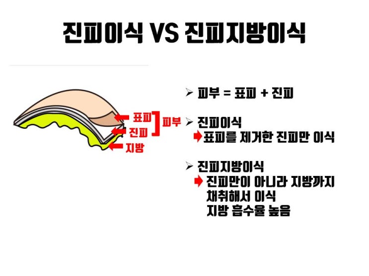  진피지방이식이 아닌 순수 진피이식으로도 무보형물 코성형이 가능해요.
