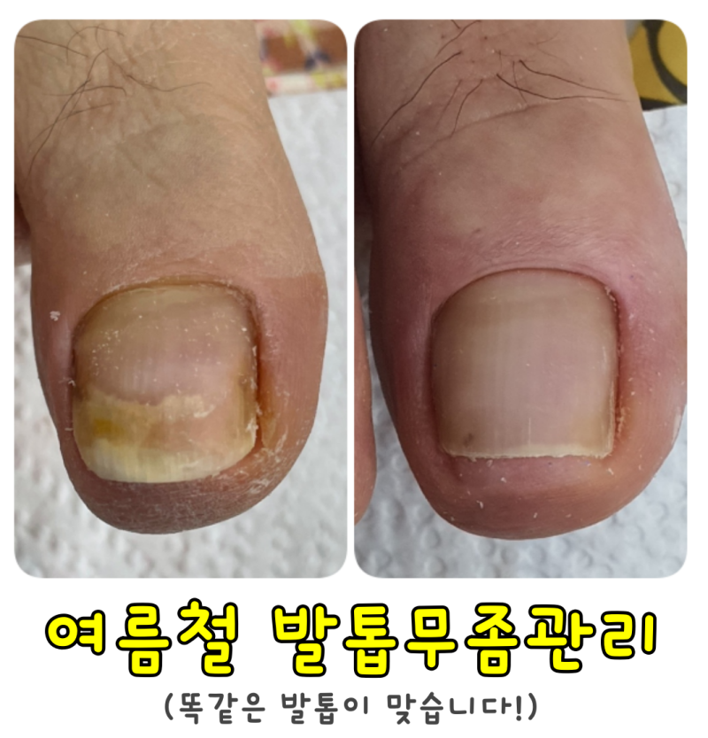 부산 손톱무좀 세심한 관리 만족 4
