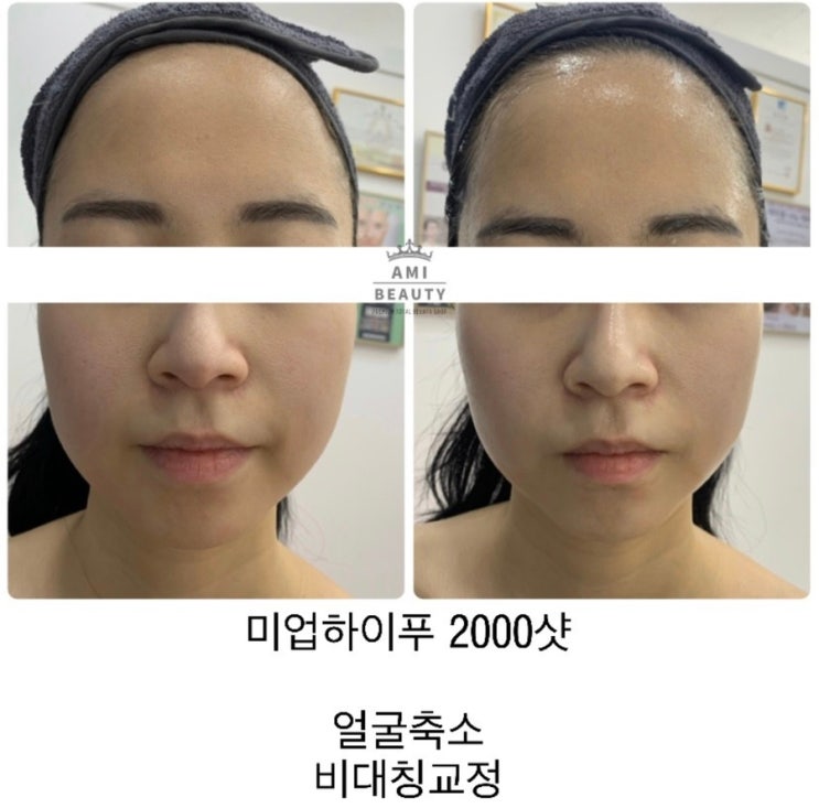  (확장이전기념)물광스킨부스터+하이프리프팅 50%할인 선착순10명