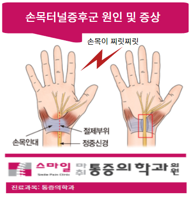  [일산손목통증치료] 손목이 찌릿찌릿: 손목통증을 유발하는 손목터널증후군 원인 및 증상