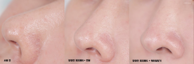 장영란 피지패드 내 돼지 내장 코 피지 제거 실패 리뷰... 2