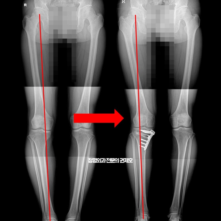 반월상연골판파열로 시행한 무릎관절경 및 근위경골절골술 CWHTO / 제이본정형외과 권제호