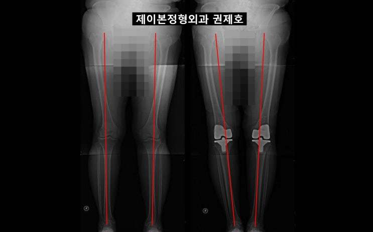  무수혈인공관절 transfusion로 양측무릎을