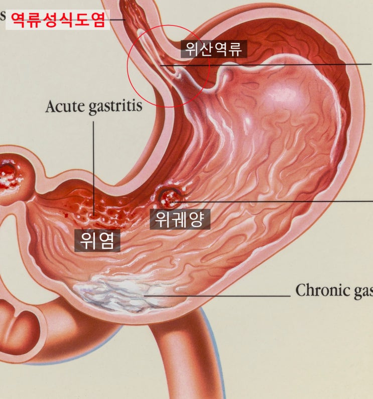  가슴쓰림, 신물을 유발하는 역류성식도염 ,어떻게?