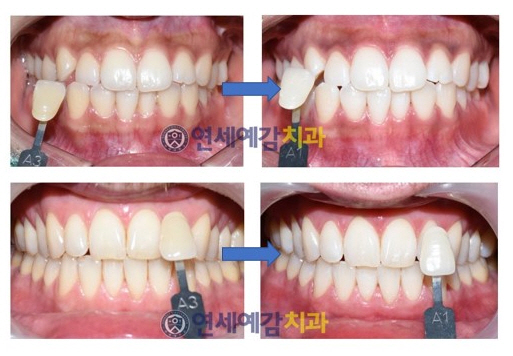  Teeth whitening in Seoul (near City Hall Station)